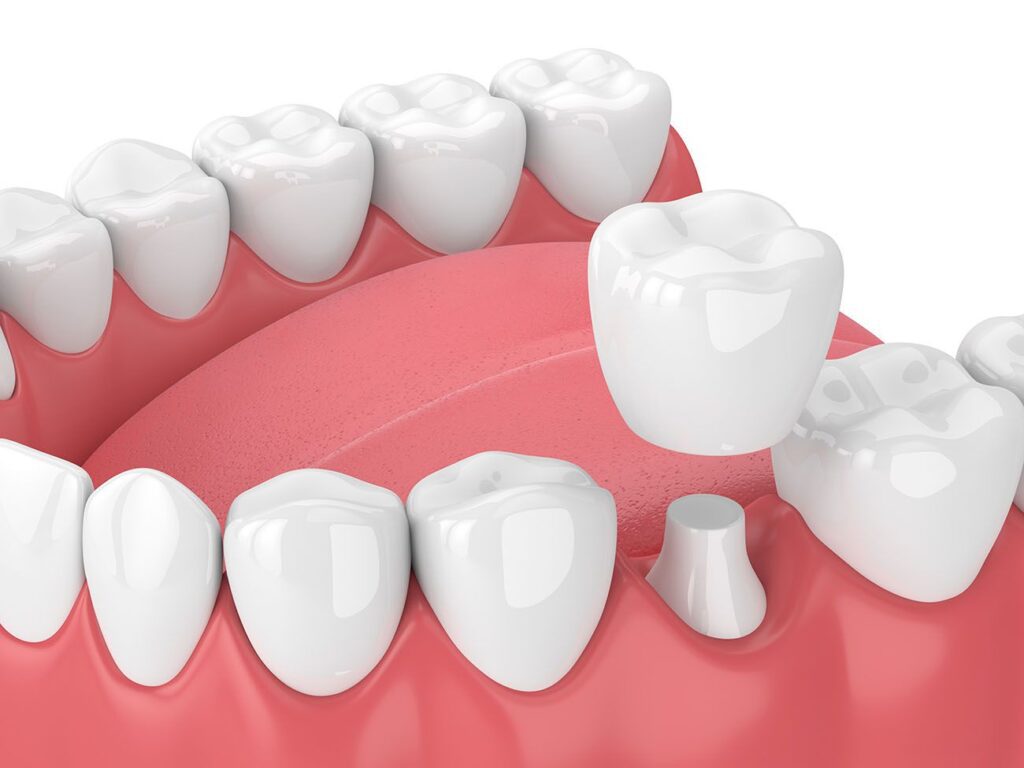 How Do Dental Crowns Help My Smile? Gaithersburg, MD Dentist