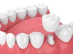 restore your smile with dental crowns