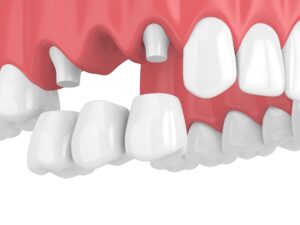 traditional fixed dental bridge tooth replacement