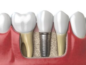 dental implant procedure expectations
